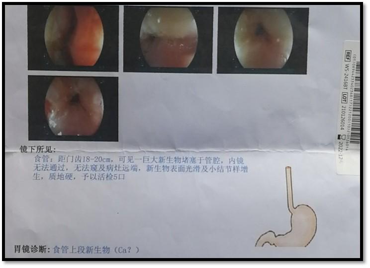 腮腺肿瘤最新的治疗方法